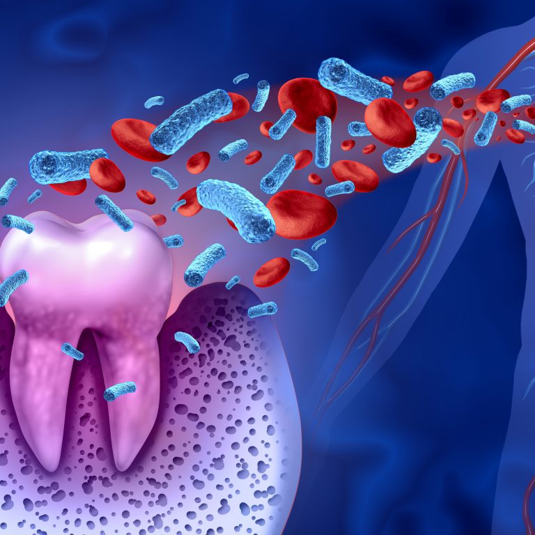 Tooth decay and heart disease as an unhealthy molar with periodontitis due to poor oral hygiene health problem as a bacteria infection in the blood as a concept with inflammation as a 3D illustration on a blue background.