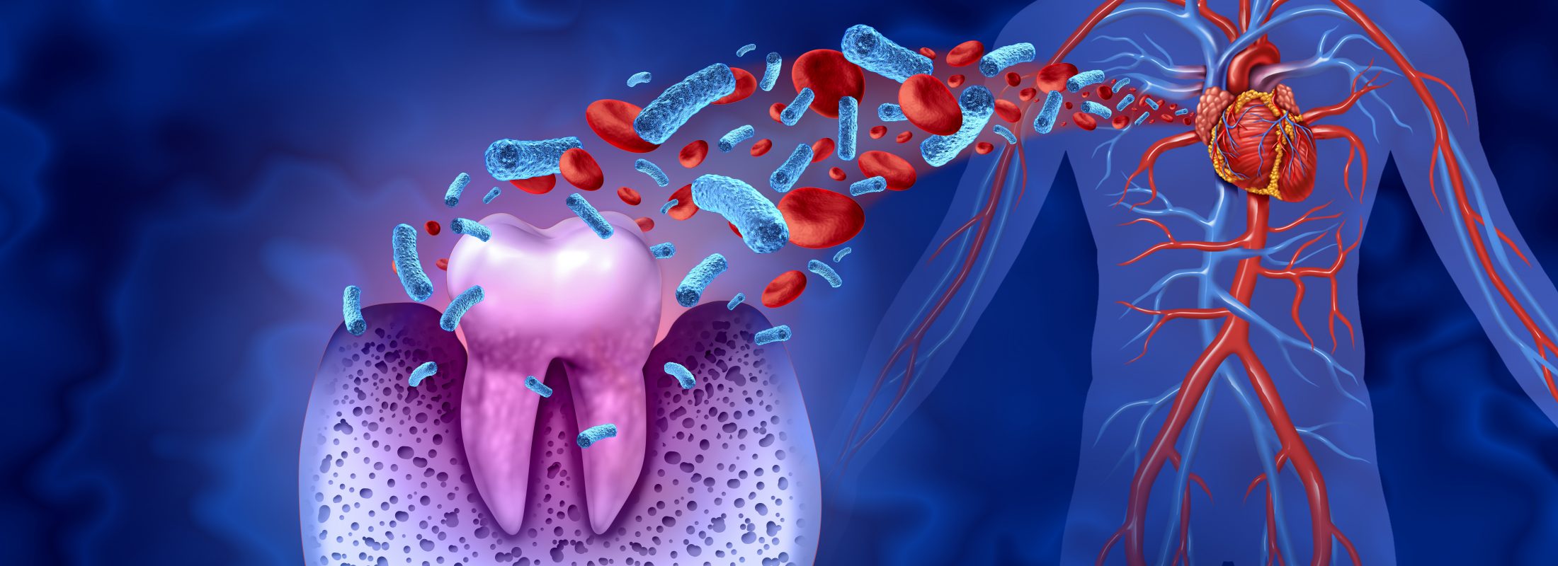 Tooth decay and heart disease as an unhealthy molar with periodontitis due to poor oral hygiene health problem as a bacteria infection in the blood as a concept with inflammation as a 3D illustration on a blue background.